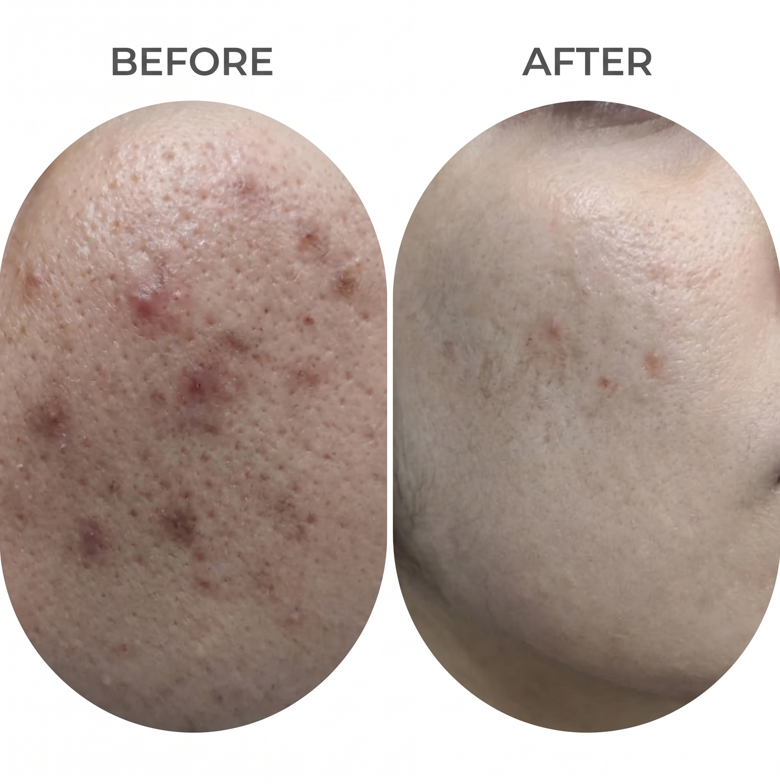Acne Scar